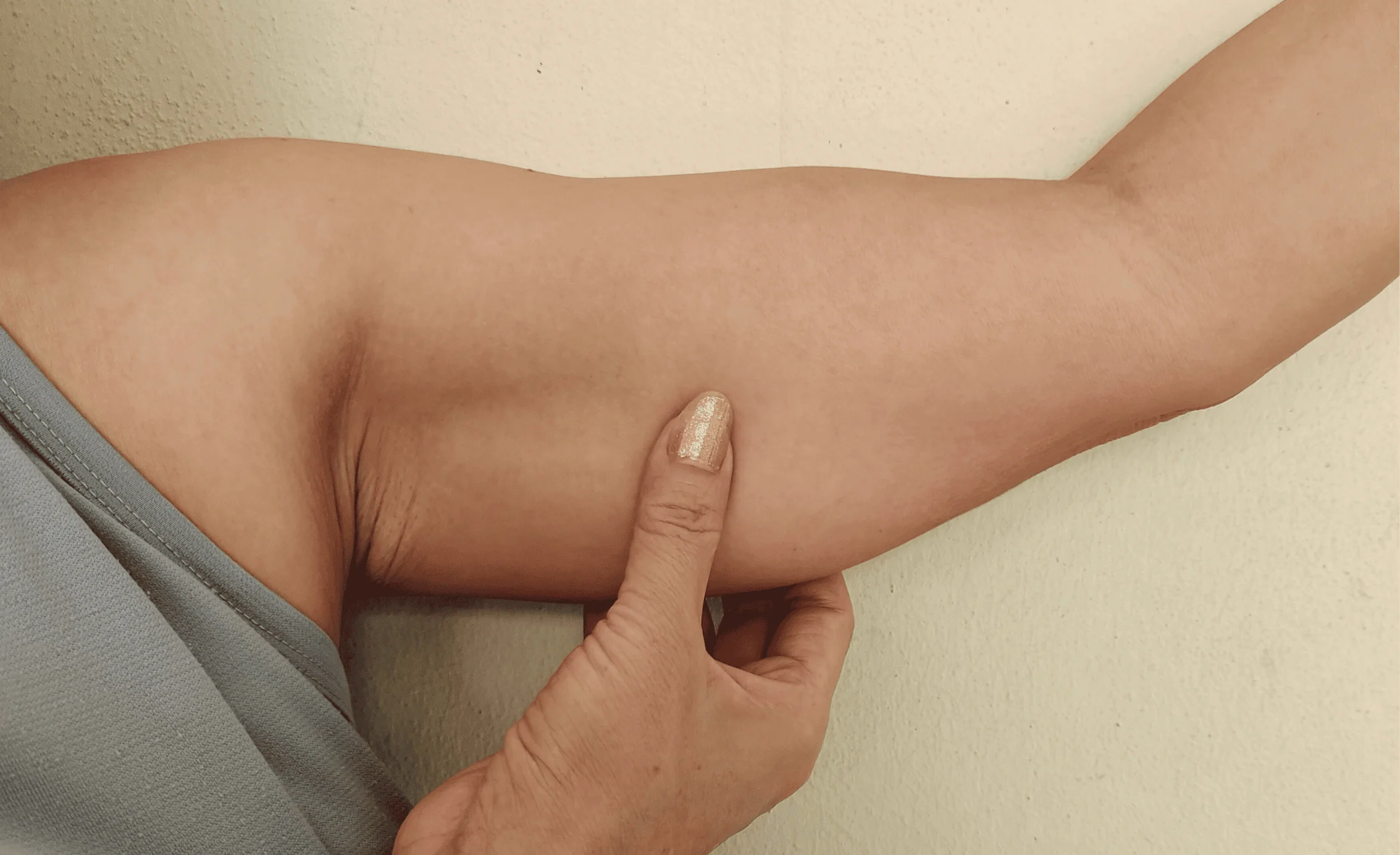 Underarm Skin Tightening