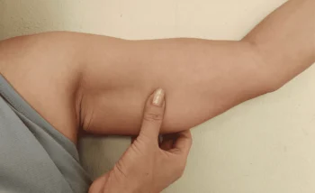 Underarm Skin Tightening